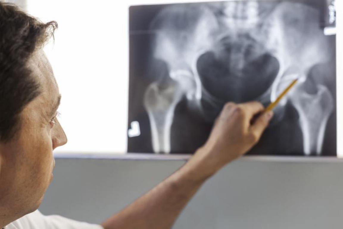 A doctor examines a hip x-ray, pointing to the clear outline of a bilateral hip replacement implant