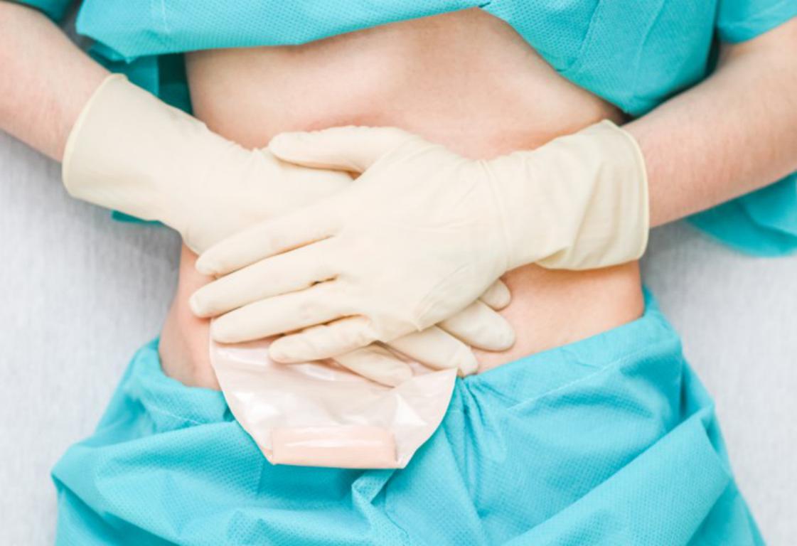  Close-up of a person wearing medical scrubs and gloves, gently holding their hands over a colostomy bag discreetly placed on their lower abdomen.