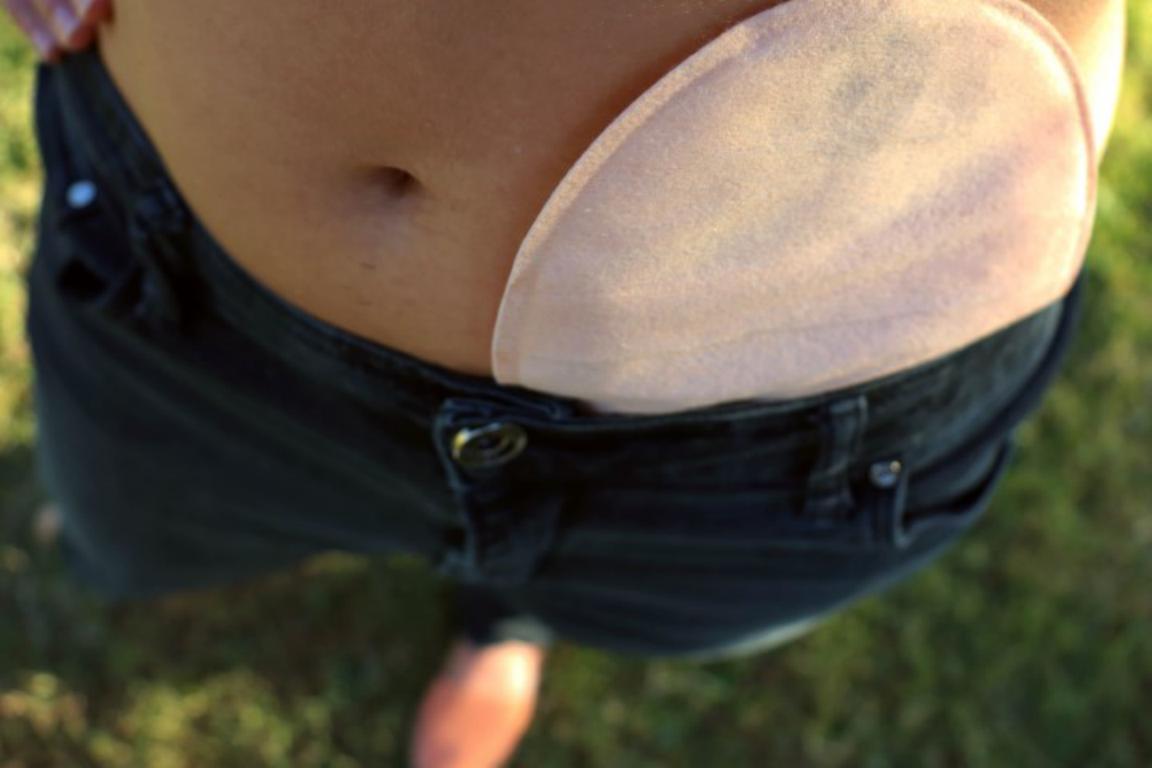 A discreet view of a colostomy bag peeking out from under the waistband of dark jeans worn by a person standing outdoors on grass, seen from a high angle.