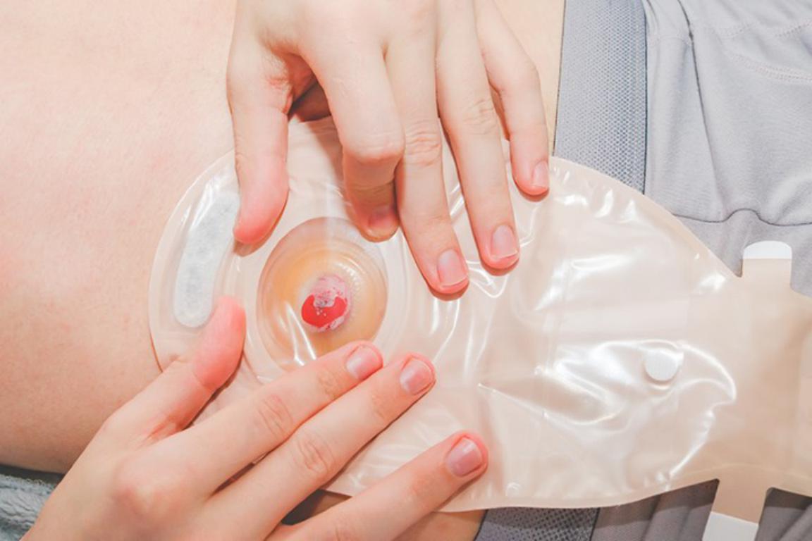 A very close-up shot of a person's hands securing a transparent colostomy bag over a prominent, reddish stoma on their abdomen.